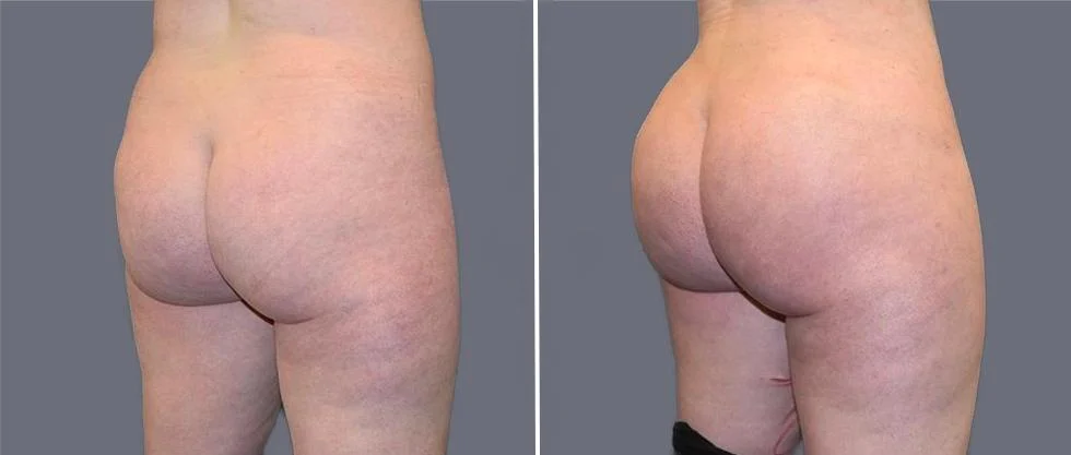 brazilian butt lift pre2024 029 before and after before and after