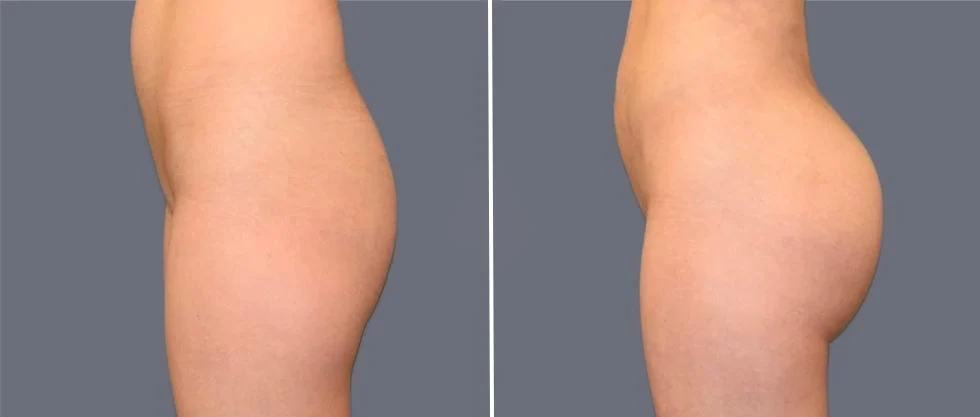 brazilian butt lift pre2024 031 before and after before and after