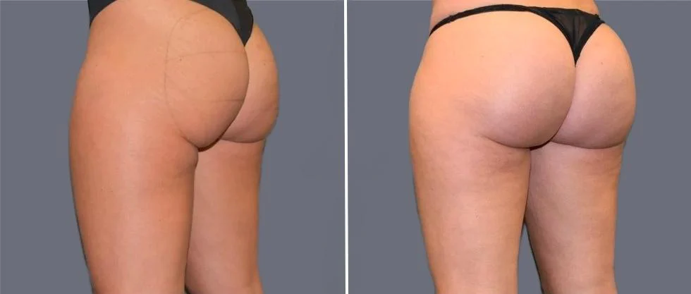 brazilian butt lift pre2024 032 before and after before and after