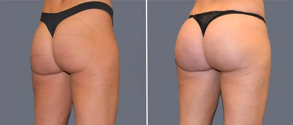 brazilian butt lift pre2024 033 before and after before and after