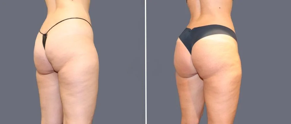 Before and after bbl brazilian butt lift of the buttocks.