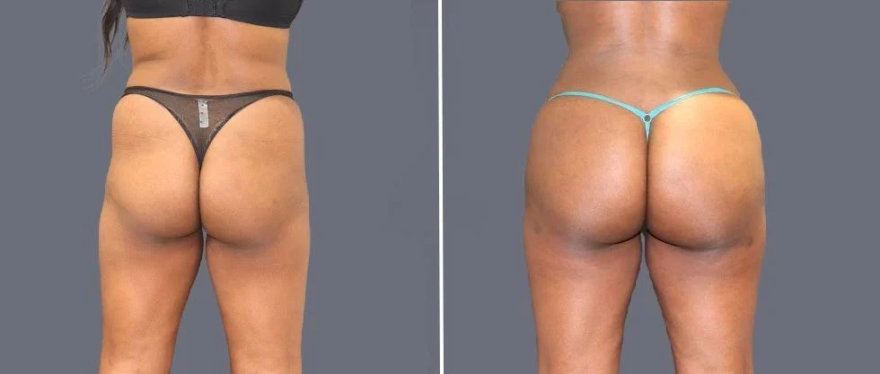 brazilian butt lift pre2024 040 before and after before and after