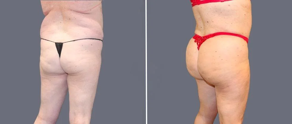 brazilian butt lift pre2024 041 before and after before and after