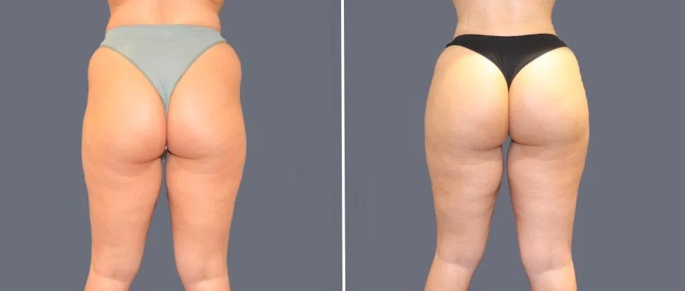 brazilian butt lift pre2024 042 before and after before and after