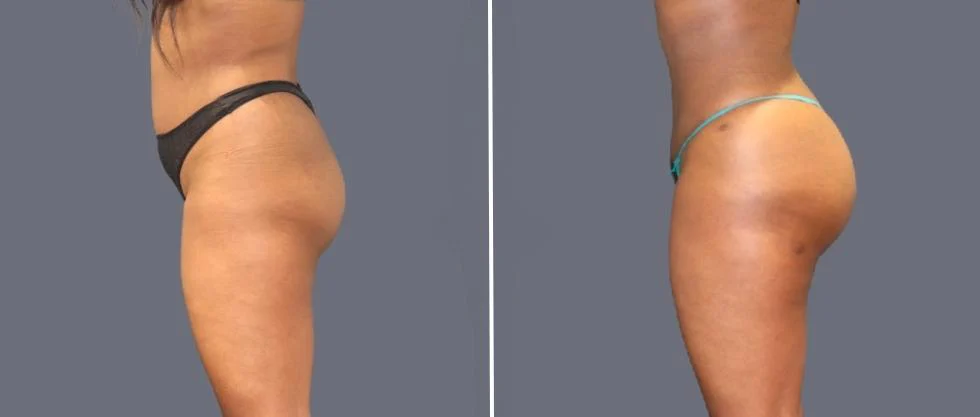 brazilian butt lift pre2024 044 before and after before and after