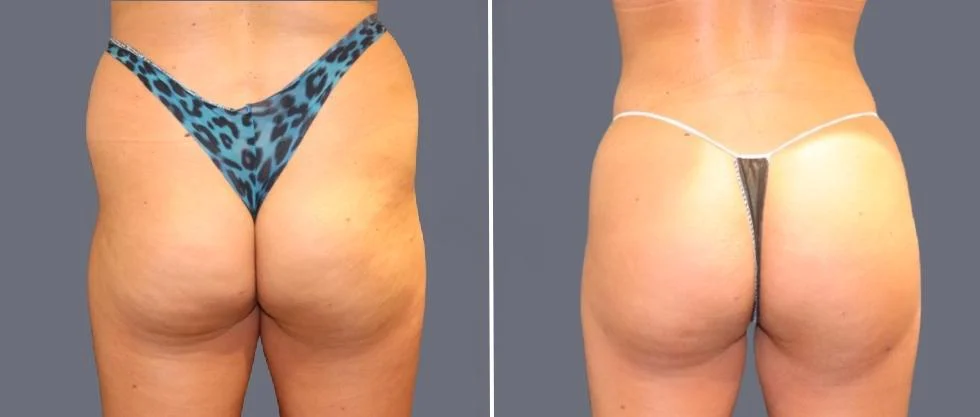 brazilian butt lift pre2024 046 before and after before and after
