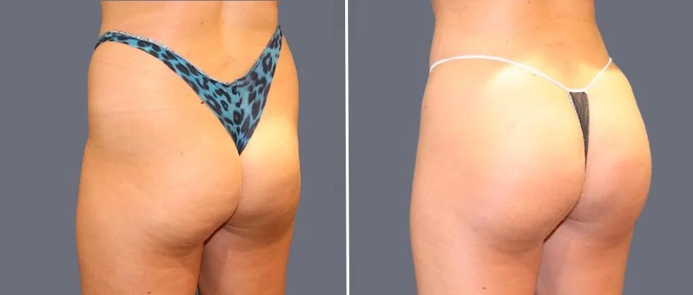 brazilian butt lift pre2024 047 before and after before and after