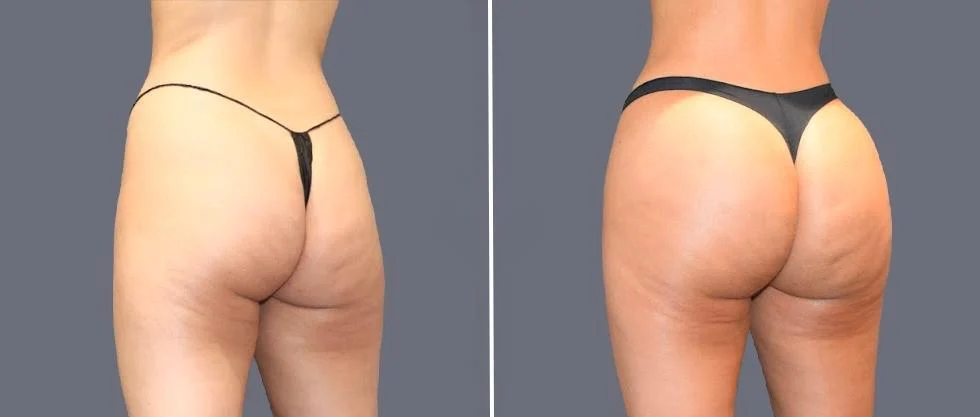 brazilian butt lift pre2024 048 before and after before and after
