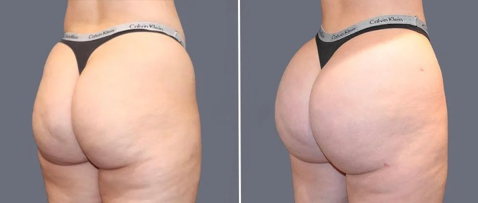 brazilian butt lift pre2024 049 before and after before and after