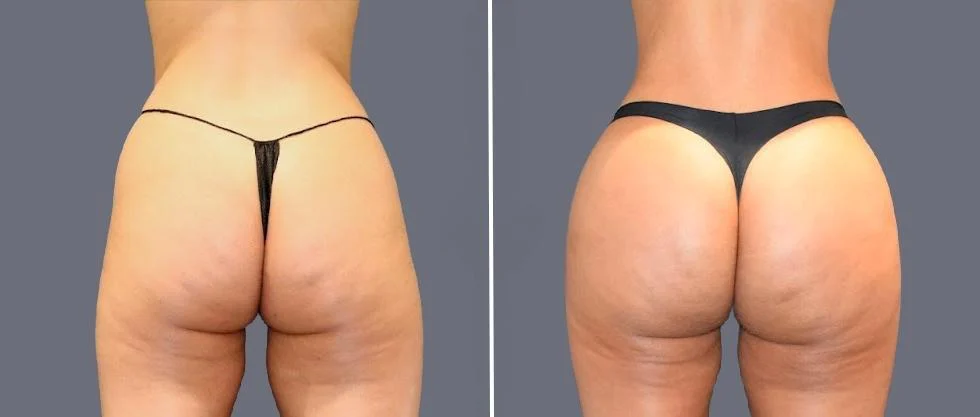 brazilian butt lift pre2024 050 before and after before and after