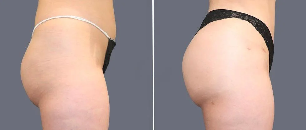 brazilian butt lift pre2024 052 before and after before and after