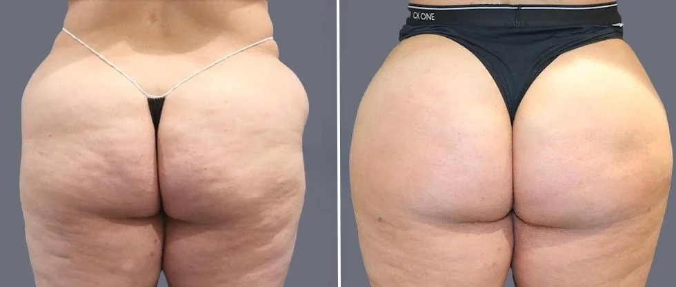 brazilian butt lift pre2024 053 before and after before and after