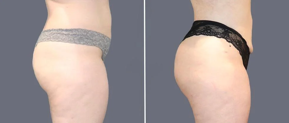 brazilian butt lift pre2024 054 before and after before and after