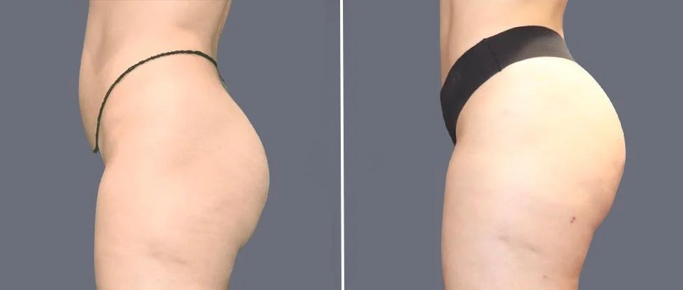brazilian butt lift pre2024 055 before and after before and after