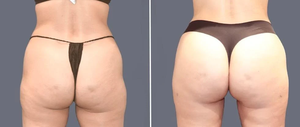 brazilian butt lift pre2024 056 before and after before and after