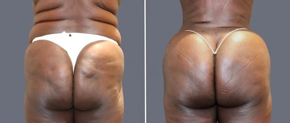brazilian butt lift pre2024 057 before and after before and after