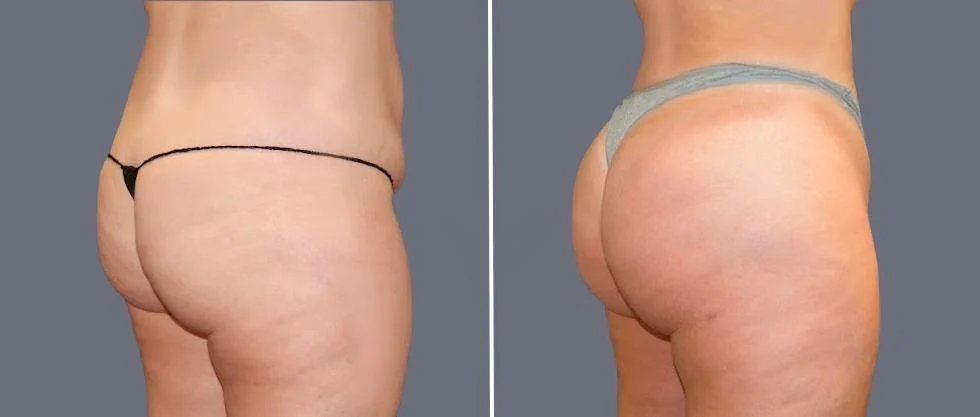 brazilian butt lift pre2024 058 before and after before and after