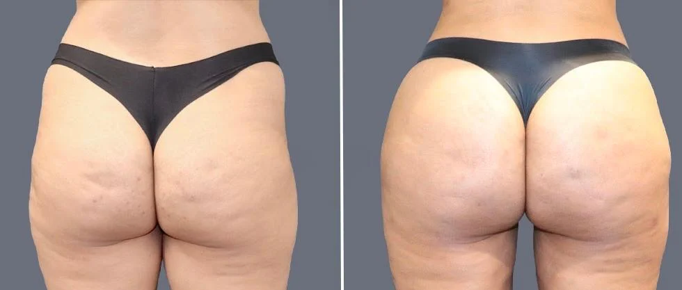 brazilian butt lift pre2024 061 before and after before and after