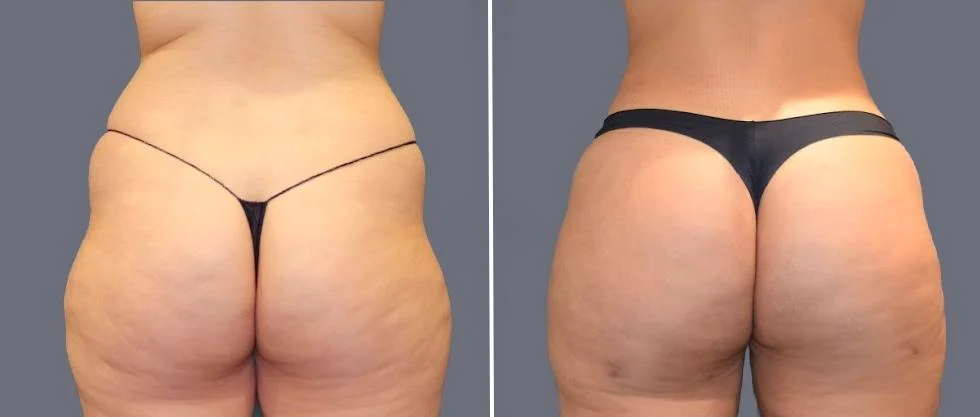 brazilian butt lift pre2024 063 before and after before and after