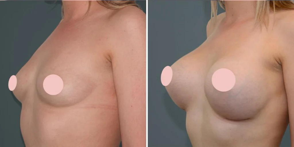 breast augmentation female pre2024 002 before and after before and after