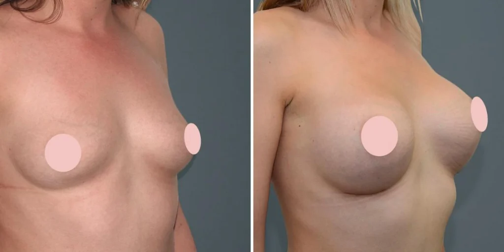 breast augmentation female pre2024 003 before and after before and after