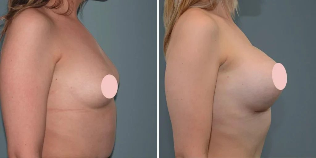 breast augmentation female pre2024 004 before and after before and after