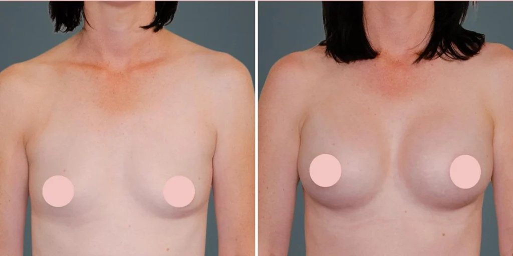 breast augmentation female pre2024 005 before and after before and after