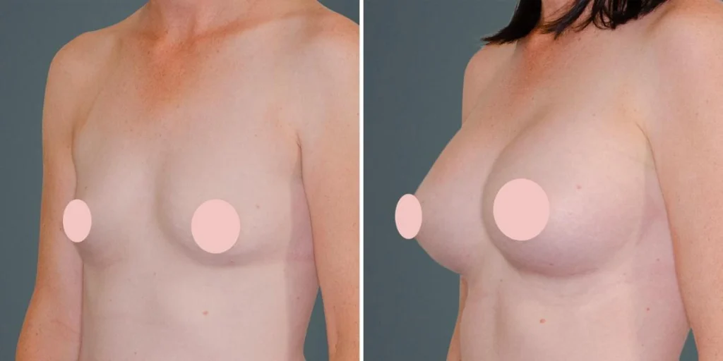 breast augmentation female pre2024 006 before and after before and after