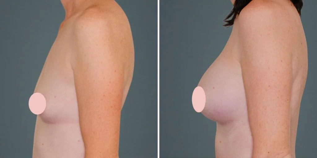 breast augmentation female pre2024 007 before and after before and after