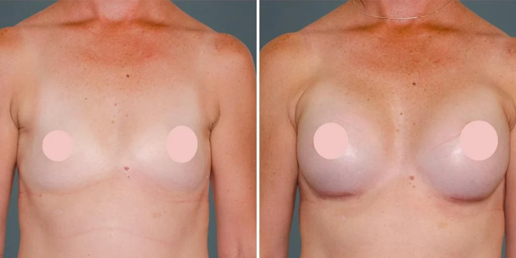 breast augmentation female pre2024 008 before and after before and after