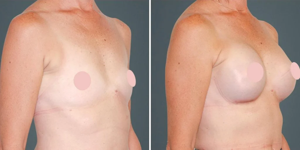 breast augmentation female pre2024 009 before and after before and after