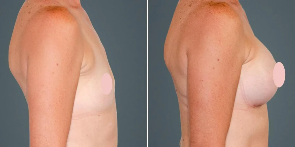 breast augmentation female pre2024 010 before and after before and after