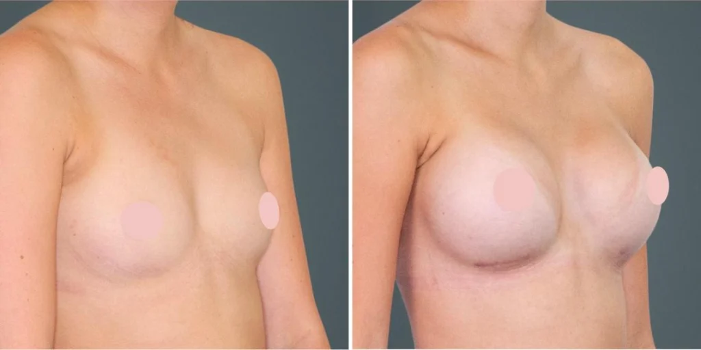 breast augmentation female pre2024 012 before and after before and after