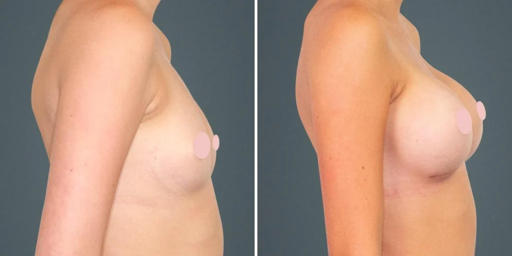 breast augmentation female pre2024 013 before and after before and after
