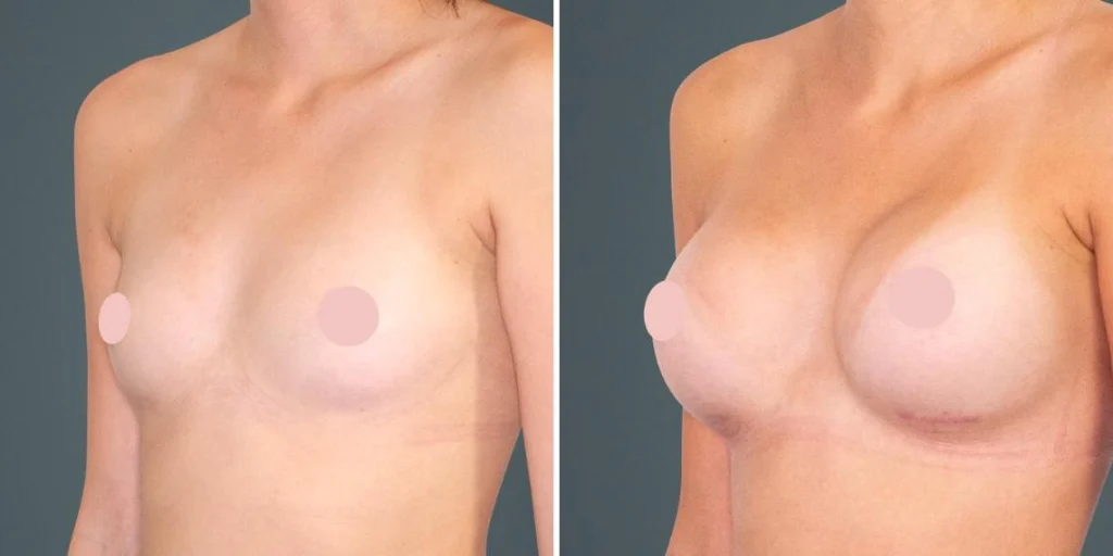 breast augmentation female pre2024 014 before and after before and after