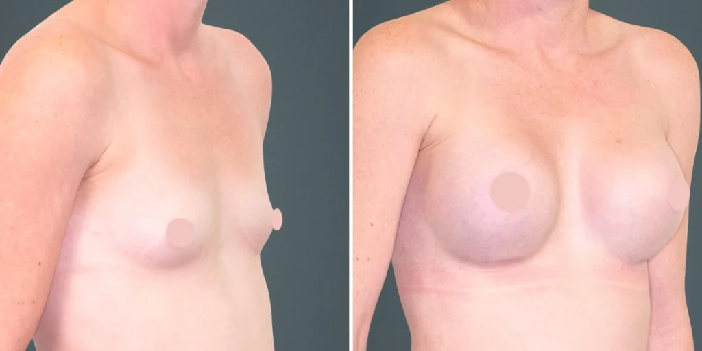 breast augmentation female pre2024 016 before and after before and after