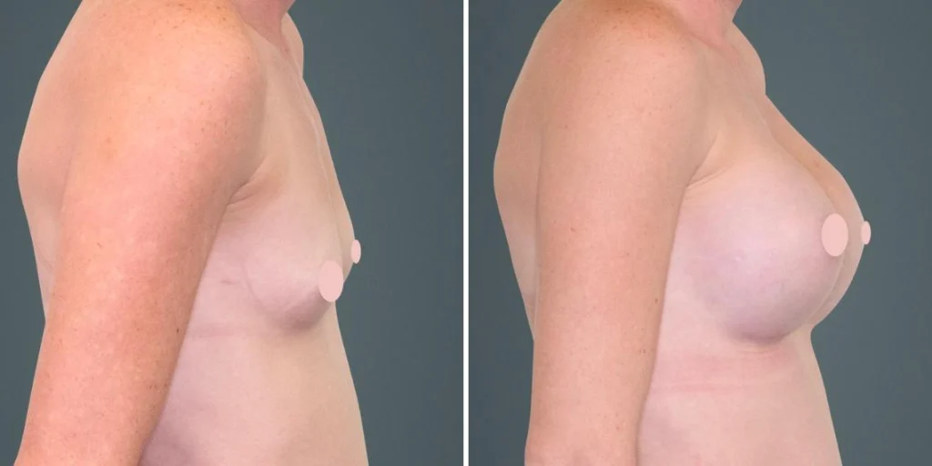 breast augmentation female pre2024 017 before and after before and after