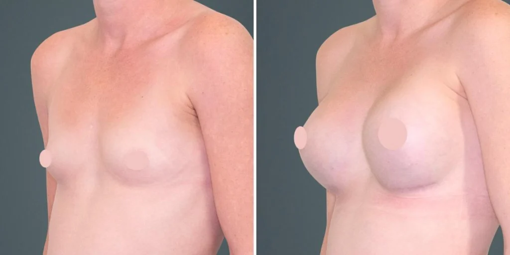 breast augmentation female pre2024 018 before and after before and after