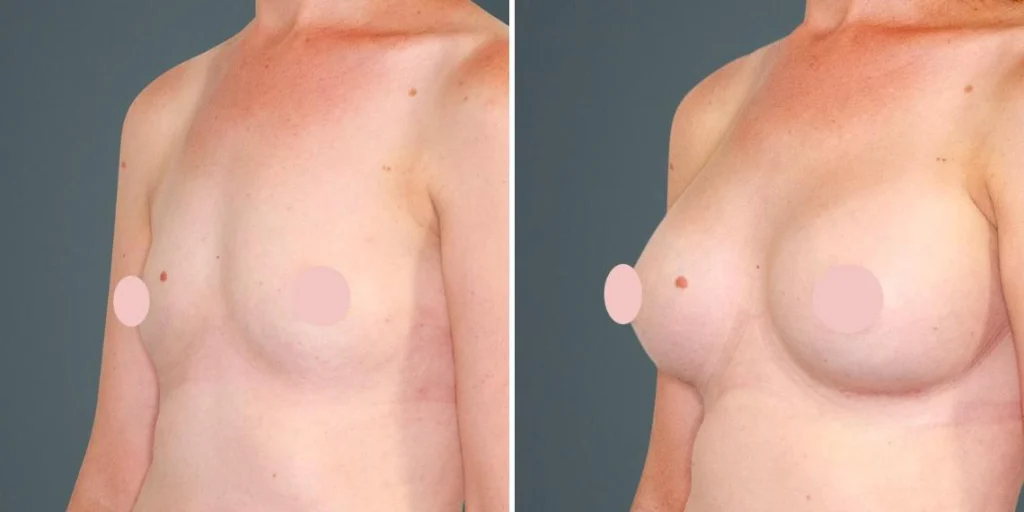 breast augmentation female pre2024 022 before and after before and after