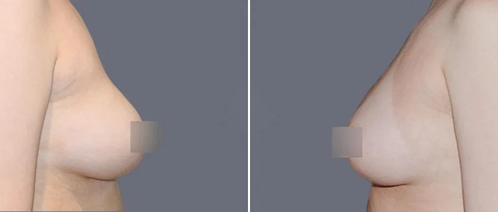 breast fat transfer pre2024 001 before and after before and after