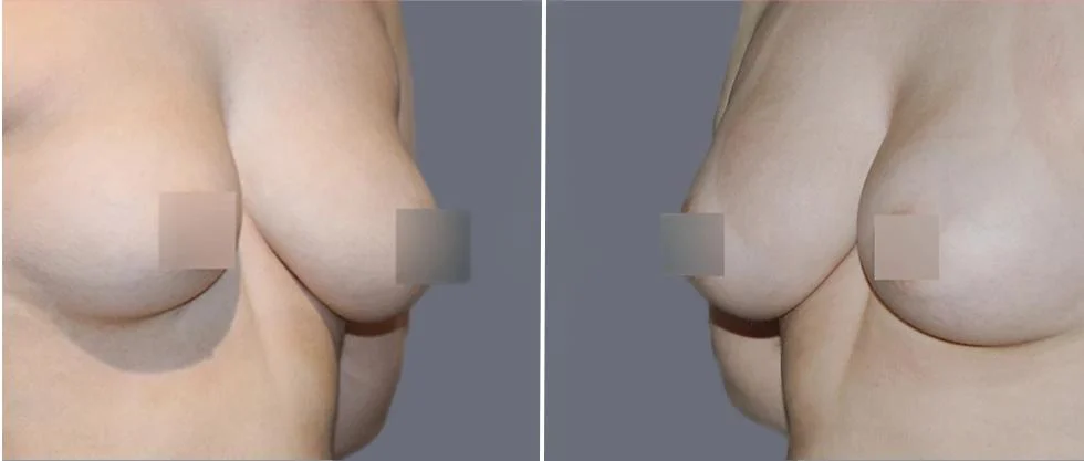 breast fat transfer pre2024 002 before and after before and after