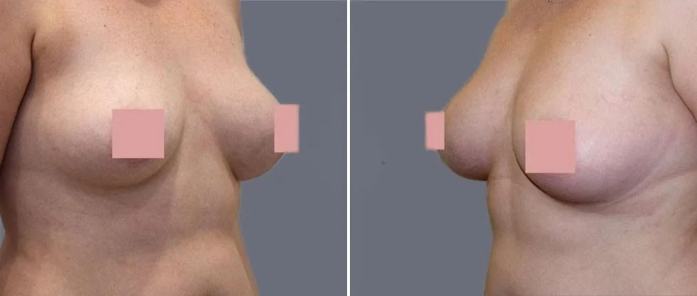 breast fat transfer pre2024 003 before and after before and after