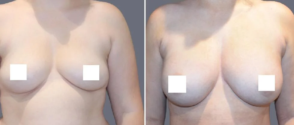 breast fat transfer pre2024 006 before and after before and after