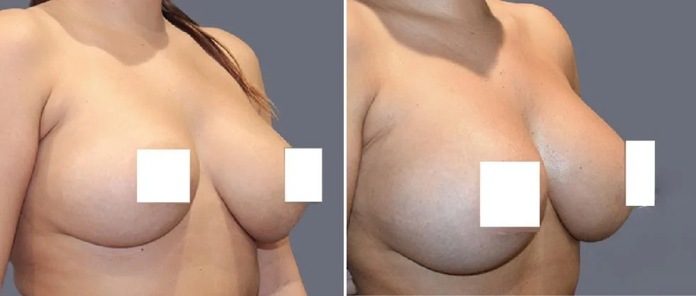 breast fat transfer pre2024 007 before and after before and after