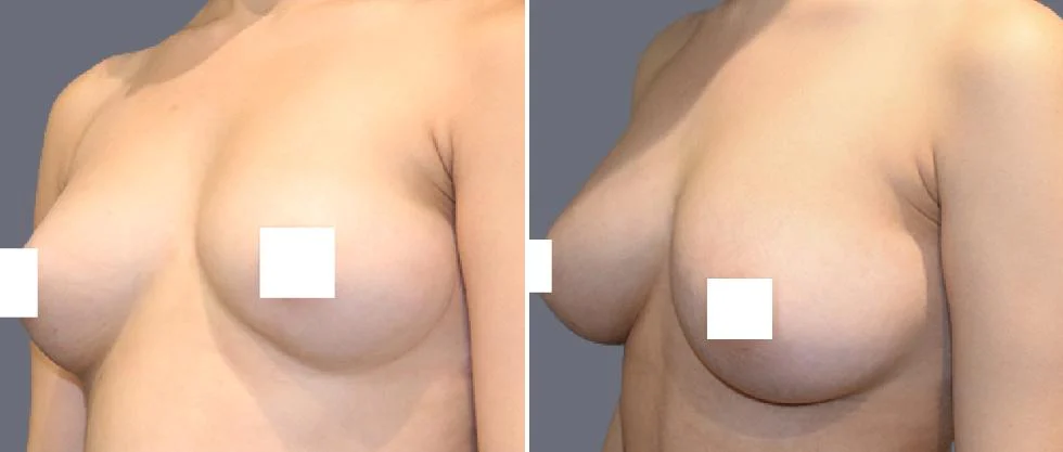 breast fat transfer pre2024 009 before and after before and after