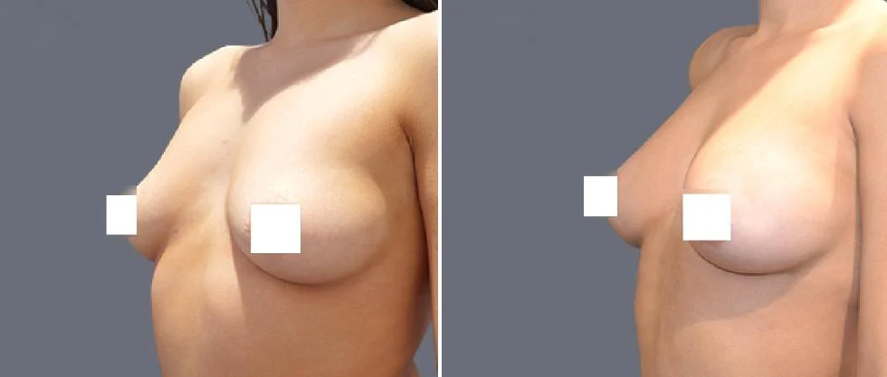breast fat transfer pre2024 010 before and after before and after