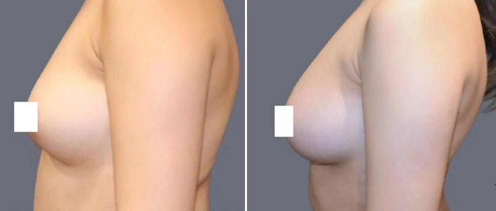 breast fat transfer pre2024 011 before and after before and after