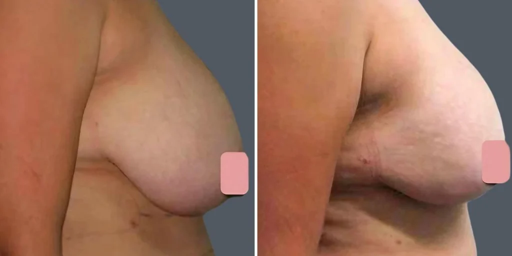 breast lift female pre2024 002 before and after before and after