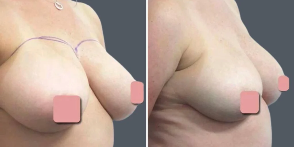 breast lift female pre2024 003 before and after before and after