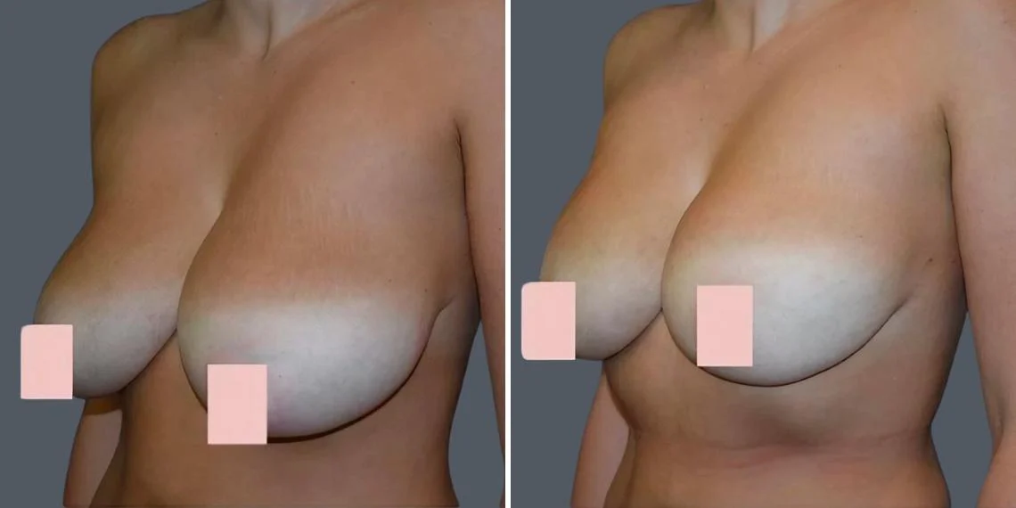 Breast Reduction Before & After before and after at Cosmos Clinic